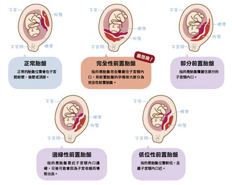 胎盤在前面